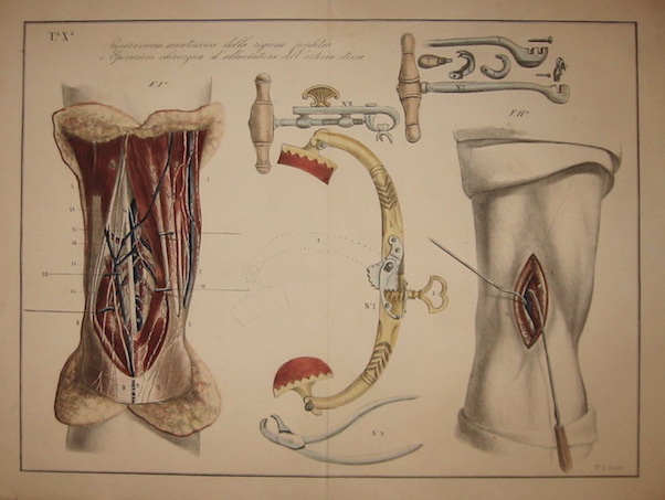 Sandri Antonio Tavola X. Preparazione anatomica della regione poplitea e operazione chirurgica d'allacciatura dell'arteria stessa 1854 Brescia